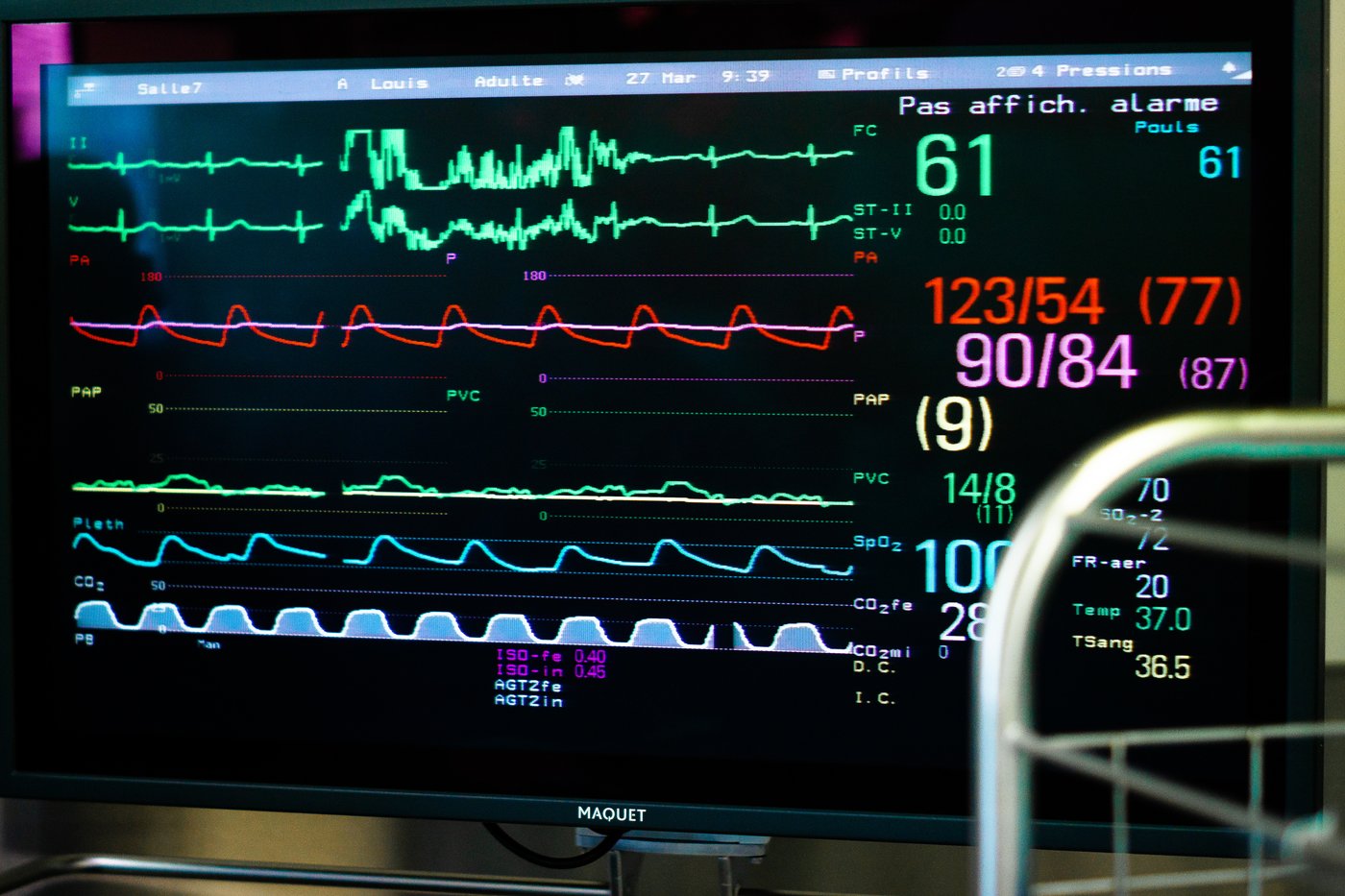 L'intelligence artificielle pourrait détecter la fibrillation auriculaire