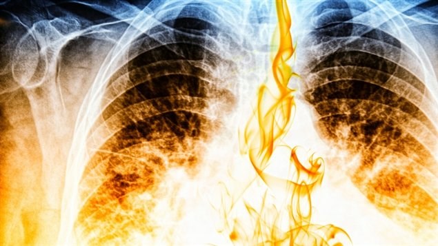 Cancer du poumon: le plus fréquent et le plus mortel au pays