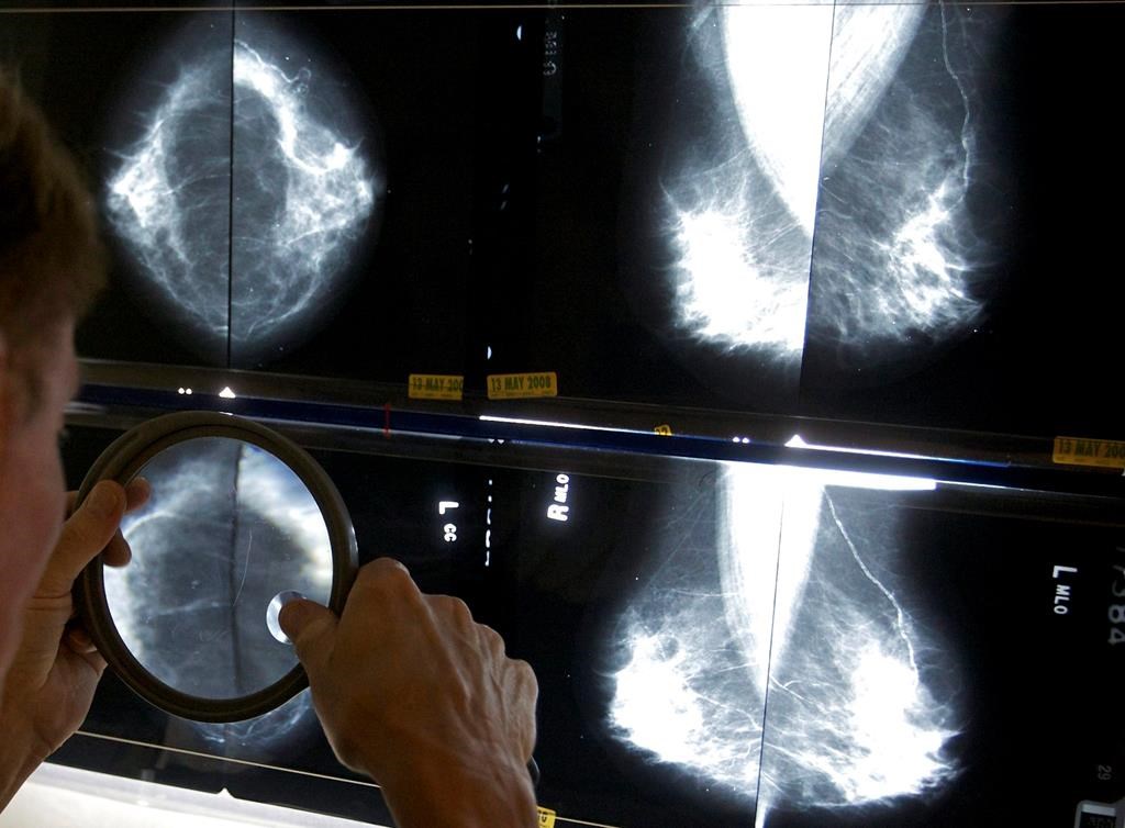 La Société canadienne du cancer réclame le dépistage du cancer du sein dès 40 ans