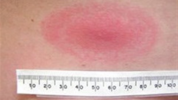 Mois de la prévention de la maladie de Lyme