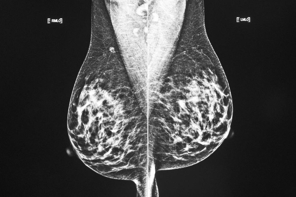 Cancer du sein: la cryoablation est offerte en première québécoise au CHUM